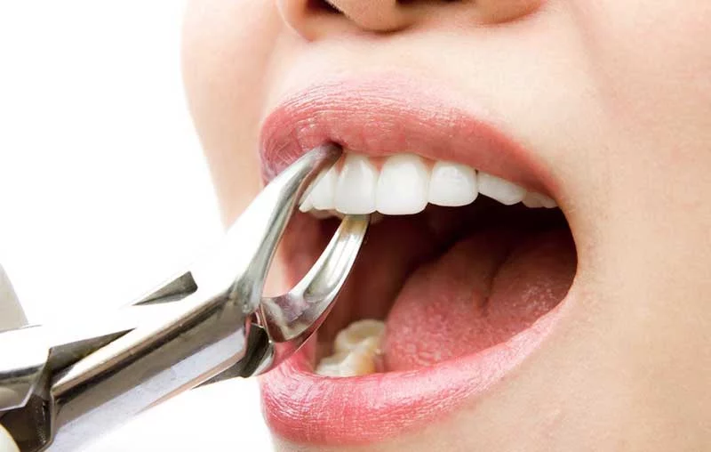 How To Get Rid of Cavity?