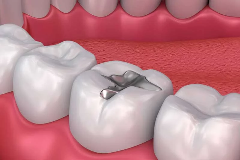How To Get Rid of Cavity?