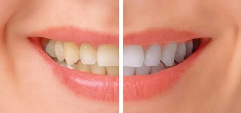 How To Get Rid of Cavity?