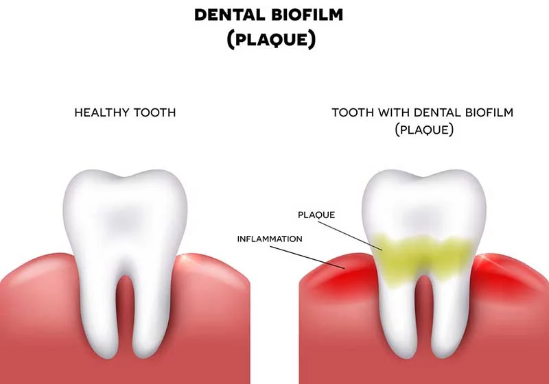 What Causes Cavities in Teeth?