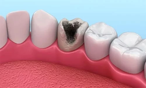 What Causes Cavities in Teeth?