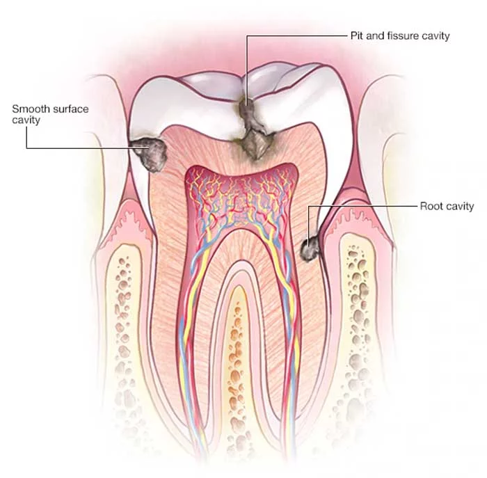 What causes cavities in teeth?