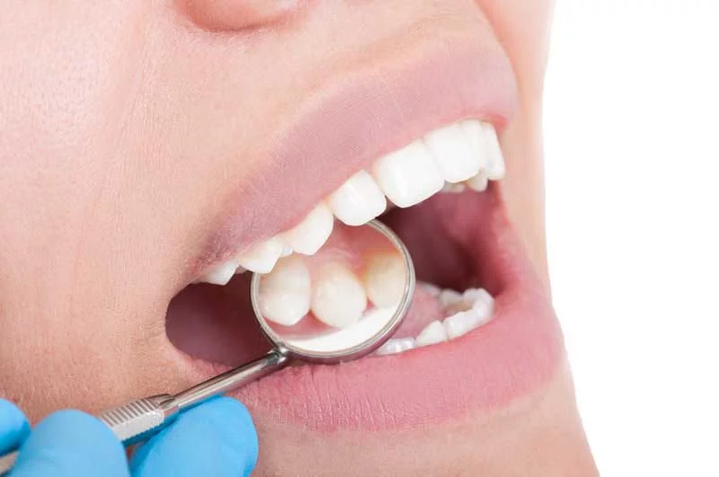 What Causes Cavities in Teeth?