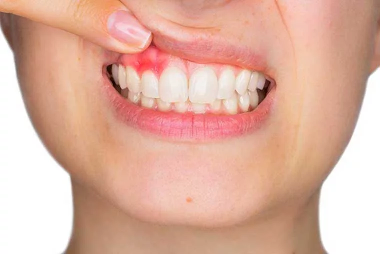 What Causes Cavities in Teeth?