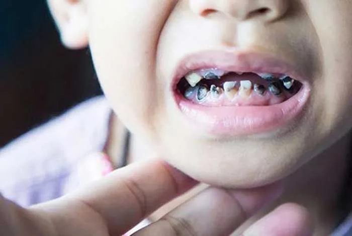 What is severe tooth decay?