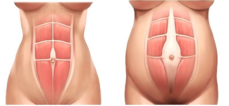 Diastasis Recti Repair: Surgery, Cost, Benefits, Risk, Procedure