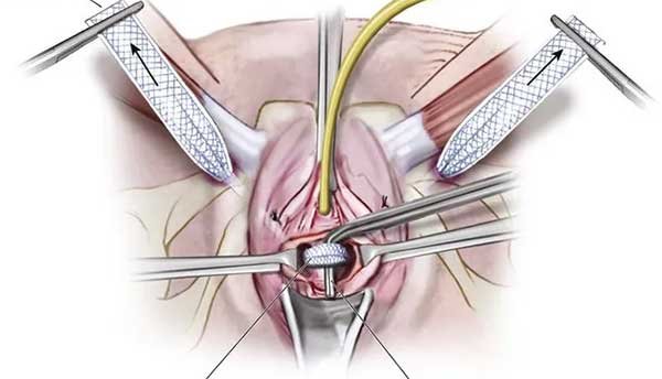 3 Types of Bladder Slings 3 Types of Bladder Slings