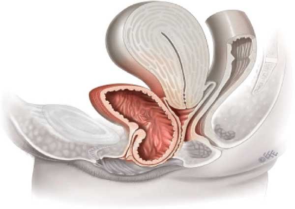 5 Complications Associated with Bladder Sling Procedures 5 Complications Associated with Bladder Sling Procedures