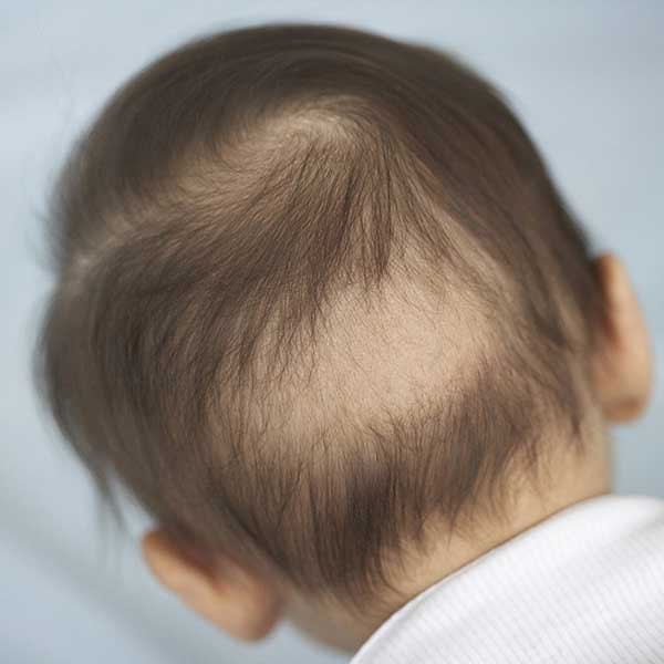 Baby bald spot remedy