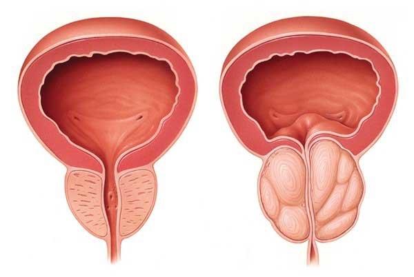 Complications Associated with Bladder Sling Procedures: Bladder Outlet Obstruction (BOO) Complications Associated with Bladder Sling Procedures: Bladder Outlet Obstruction (BOO)