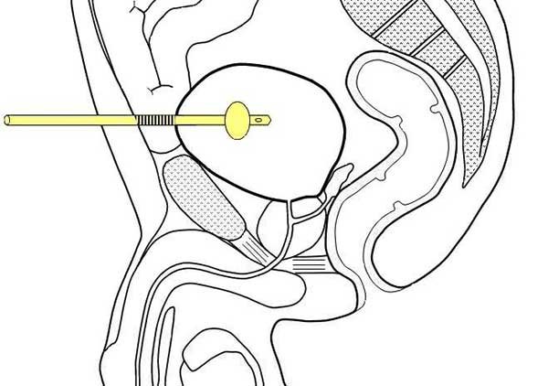 Bladder and Bowel Perforation Bladder and Bowel Perforation