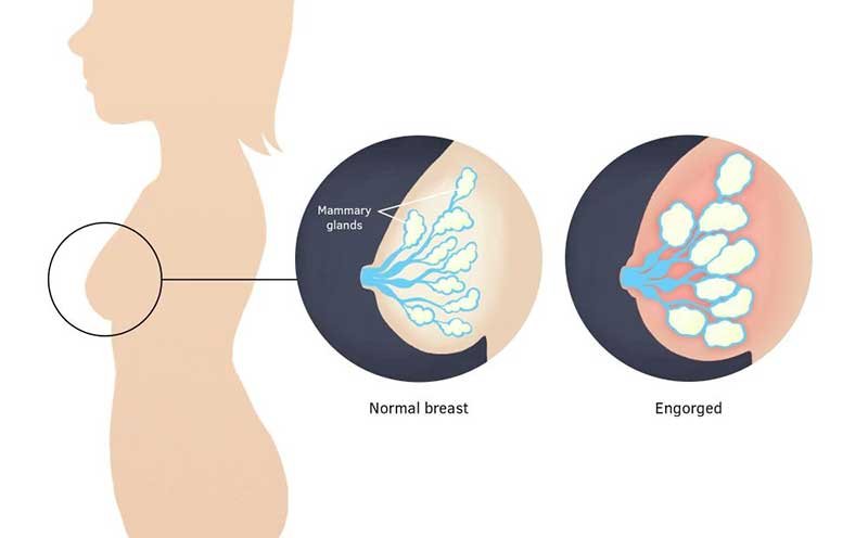Sharp Pain in Breast while Breastfeeding: Breast Engorgement