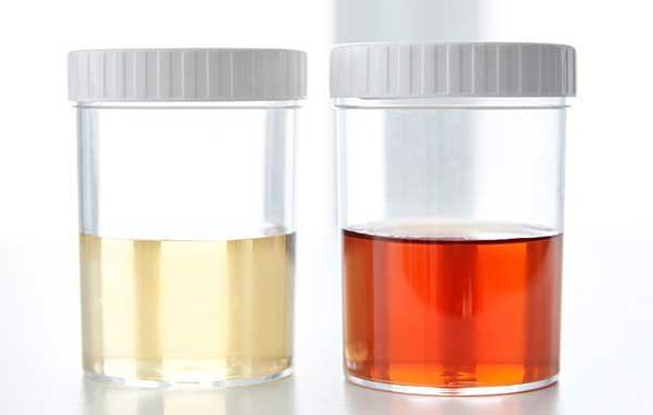 Can blood in urine be an std?