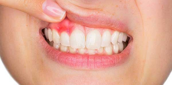 Dental Anesthesia Side Effects Dental Anesthesia Side Effects