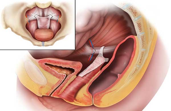 Has there Been a Recall of Transvaginal Mesh? Has there Been a Recall of Transvaginal Mesh?
