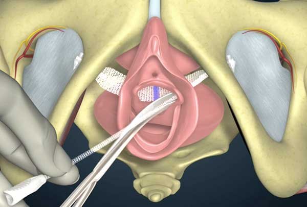 How is bladder sling surgery performed? How is bladder sling surgery performed?