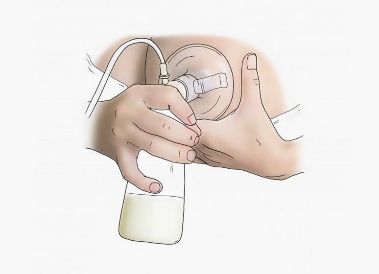 How to treat clogged milk ducts?