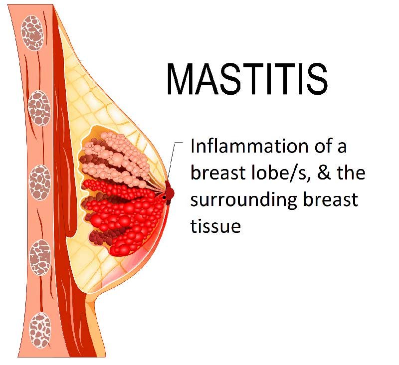 Sharp Pain in Breast while Breastfeeding: Mastitis