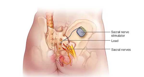 Types of Bladder Slings: Nerve Stimulation to Treat Overactive Bladder Types of Bladder Slings: Nerve Stimulation to Treat Overactive Bladder