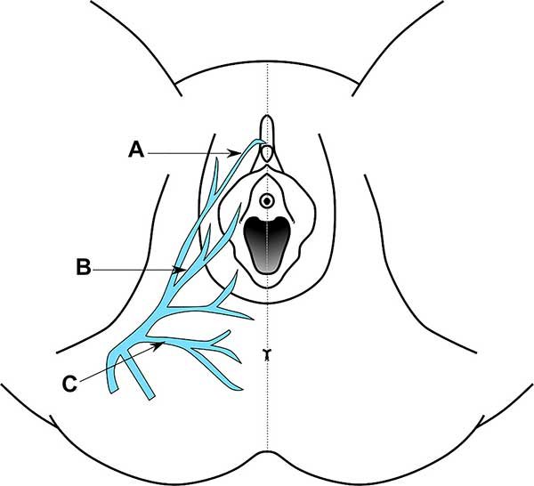 Pudendal Neuralgia Pudendal Neuralgia