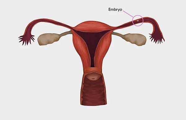Spotting during the First trimester