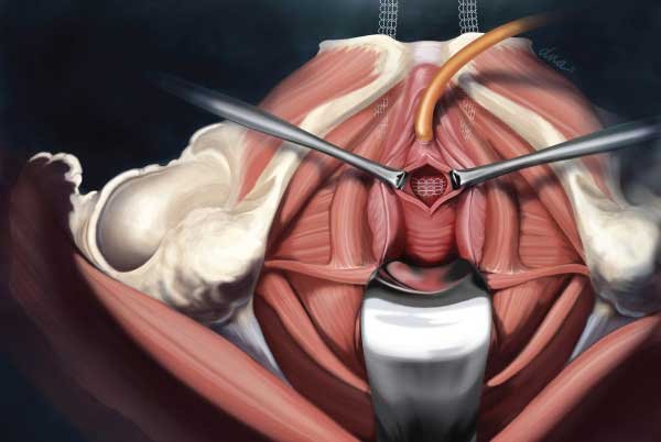 Symptoms of Extrusion Symptoms of Extrusion