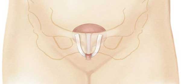 Types of Bladder Slings: Tension-free Sling Types of Bladder Slings: Tension-free Sling