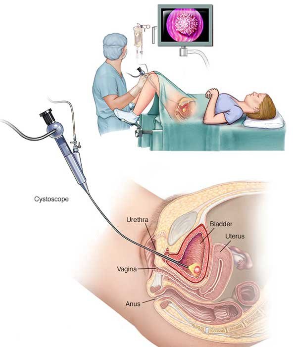 UTI  Common Symptoms