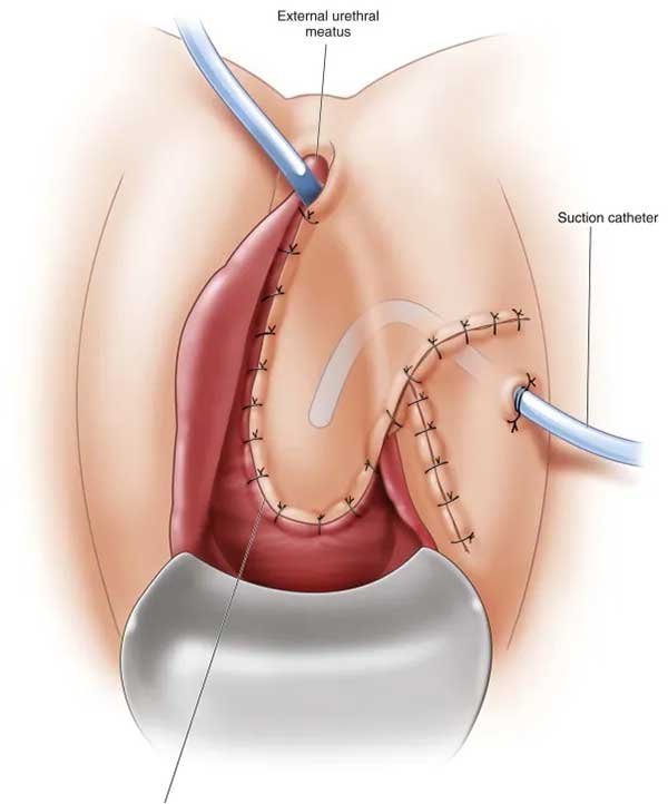 Complications Associated with Bladder Sling Procedures: Urethral Erosion Complications Associated with Bladder Sling Procedures: Urethral Erosion