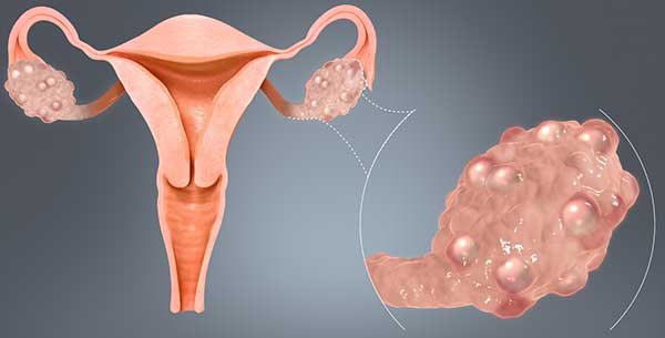 What is Polycystic Ovarian Syndrome? What is Polycystic Ovarian Syndrome?