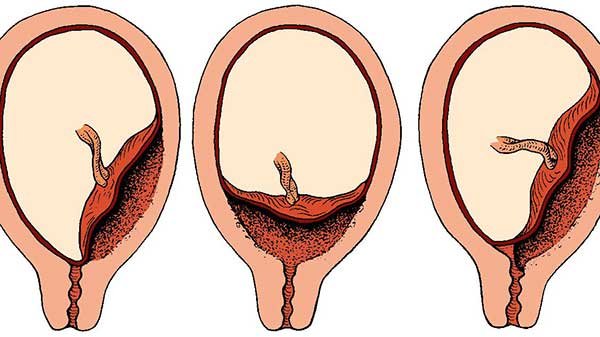What problems with the placenta can cause bleeding during pregnancy?